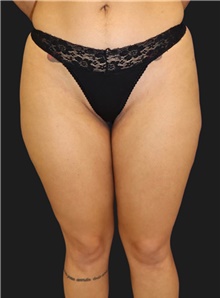 Liposuction Before Photo by Munique Maia, MD; Tysons Corner, VA - Case 48868
