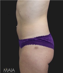 Liposuction Before Photo by Munique Maia, MD; Tysons Corner, VA - Case 48869
