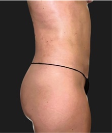 Liposuction After Photo by Munique Maia, MD; Tysons Corner, VA - Case 48869