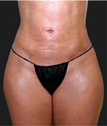 Liposuction After Photo by Munique Maia, MD; Tysons Corner, VA - Case 48869