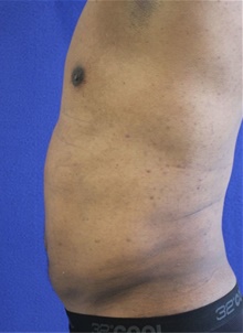 Liposuction After Photo by Munique Maia, MD; Tysons Corner, VA - Case 48870