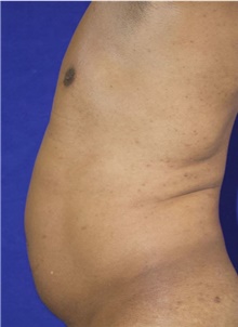 Liposuction Before Photo by Munique Maia, MD; Tysons Corner, VA - Case 48870