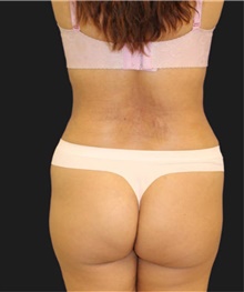 Liposuction After Photo by Munique Maia, MD; Tysons Corner, VA - Case 48871