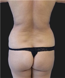 Liposuction Before Photo by Munique Maia, MD; Tysons Corner, VA - Case 48871