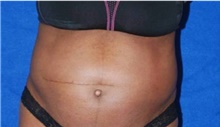 Liposuction Before Photo by Munique Maia, MD; Tysons Corner, VA - Case 48874