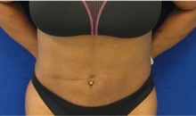 Liposuction After Photo by Munique Maia, MD; Tysons Corner, VA - Case 48874