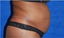 Liposuction Before Photo by Munique Maia, MD; Tysons Corner, VA - Case 48874