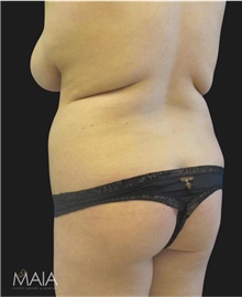 Liposuction Before Photo by Munique Maia, MD; Tysons Corner, VA - Case 48876