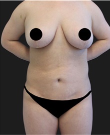 Liposuction After Photo by Munique Maia, MD; Tysons Corner, VA - Case 48876
