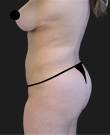 Liposuction After Photo by Munique Maia, MD; Tysons Corner, VA - Case 48876