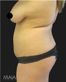 Liposuction Before Photo by Munique Maia, MD; Tysons Corner, VA - Case 48876