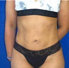 Liposuction After Photo by Munique Maia, MD; Tysons Corner, VA - Case 48878