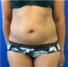 Liposuction Before Photo by Munique Maia, MD; Tysons Corner, VA - Case 48878
