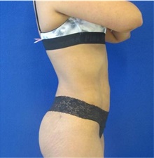 Liposuction After Photo by Munique Maia, MD; Tysons Corner, VA - Case 48878