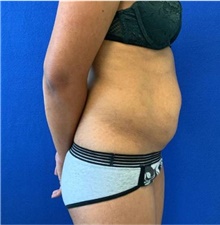 Liposuction Before Photo by Munique Maia, MD; Tysons Corner, VA - Case 48878