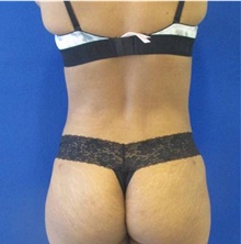 Liposuction After Photo by Munique Maia, MD; Tysons Corner, VA - Case 48878