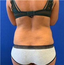 Liposuction Before Photo by Munique Maia, MD; Tysons Corner, VA - Case 48878