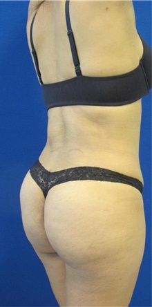 Liposuction After Photo by Munique Maia, MD; Tysons Corner, VA - Case 48879
