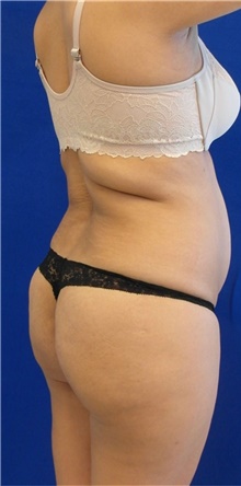 Liposuction Before Photo by Munique Maia, MD; Tysons Corner, VA - Case 48879