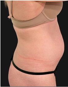 Tummy Tuck Before Photo by Munique Maia, MD; Tysons Corner, VA - Case 48881