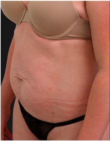 Tummy Tuck Before Photo by Munique Maia, MD; Tysons Corner, VA - Case 48881