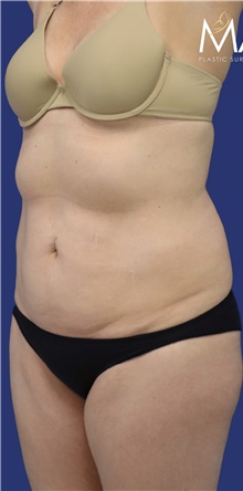 Tummy Tuck Before Photo by Munique Maia, MD; Tysons Corner, VA - Case 48882