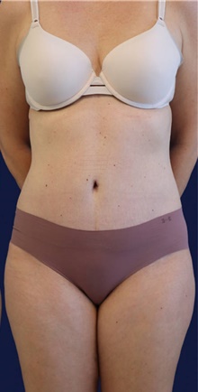 Tummy Tuck After Photo by Munique Maia, MD; Tysons Corner, VA - Case 48919
