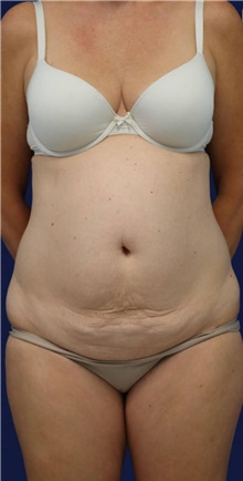 Tummy Tuck Before Photo by Munique Maia, MD; Tysons Corner, VA - Case 48919