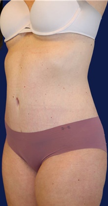 Tummy Tuck After Photo by Munique Maia, MD; Tysons Corner, VA - Case 48919