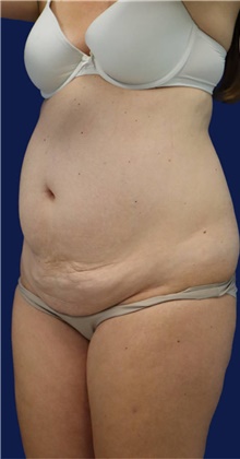 Tummy Tuck Before Photo by Munique Maia, MD; Tysons Corner, VA - Case 48919