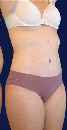 Tummy Tuck After Photo by Munique Maia, MD; Tysons Corner, VA - Case 48919