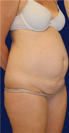 Tummy Tuck Before Photo by Munique Maia, MD; Tysons Corner, VA - Case 48919