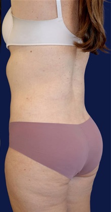 Tummy Tuck After Photo by Munique Maia, MD; Tysons Corner, VA - Case 48919