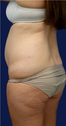 Tummy Tuck Before Photo by Munique Maia, MD; Tysons Corner, VA - Case 48919