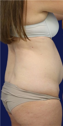 Tummy Tuck Before Photo by Munique Maia, MD; Tysons Corner, VA - Case 48919