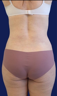 Tummy Tuck After Photo by Munique Maia, MD; Tysons Corner, VA - Case 48919