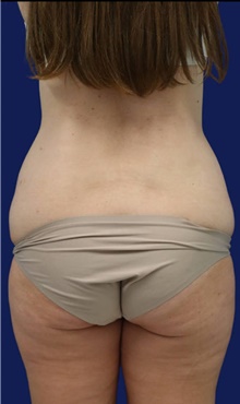 Tummy Tuck Before Photo by Munique Maia, MD; Tysons Corner, VA - Case 48919