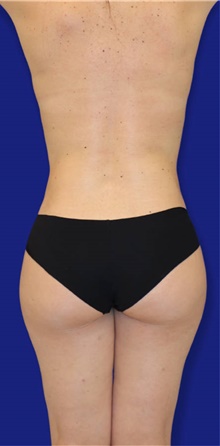 Tummy Tuck After Photo by Munique Maia, MD; Tysons Corner, VA - Case 48920