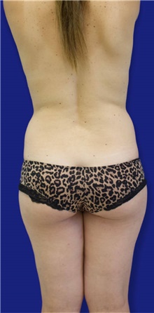 Tummy Tuck Before Photo by Munique Maia, MD; Tysons Corner, VA - Case 48920