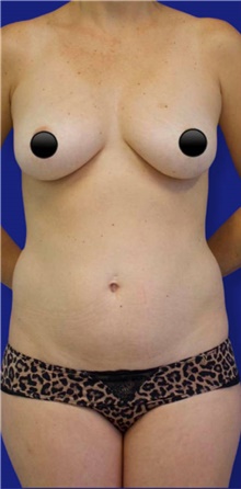 Tummy Tuck Before Photo by Munique Maia, MD; Tysons Corner, VA - Case 48920