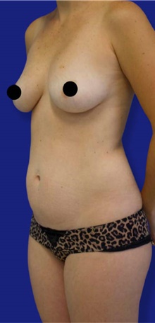 Tummy Tuck Before Photo by Munique Maia, MD; Tysons Corner, VA - Case 48920