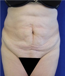 Tummy Tuck Before Photo by Munique Maia, MD; Tysons Corner, VA - Case 48924