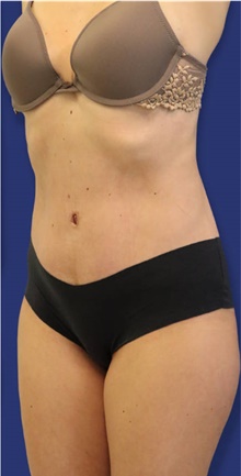 Tummy Tuck After Photo by Munique Maia, MD; Tysons Corner, VA - Case 48927