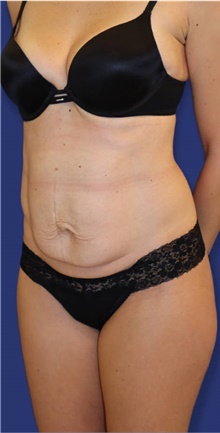 Tummy Tuck Before Photo by Munique Maia, MD; Tysons Corner, VA - Case 48927