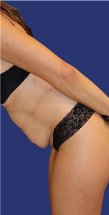 Tummy Tuck Before Photo by Munique Maia, MD; Tysons Corner, VA - Case 48927