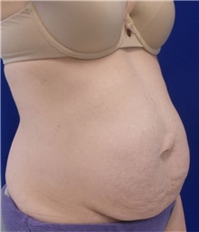 Tummy Tuck Before Photo by Munique Maia, MD; Tysons Corner, VA - Case 48932