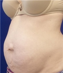 Tummy Tuck Before Photo by Munique Maia, MD; Tysons Corner, VA - Case 48932
