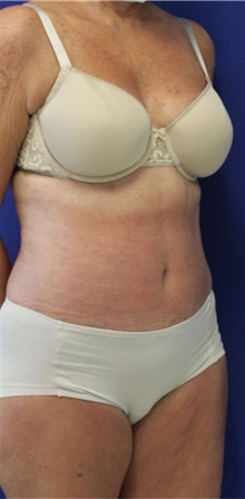 Tummy Tuck After Photo by Munique Maia, MD; Tysons Corner, VA - Case 48935