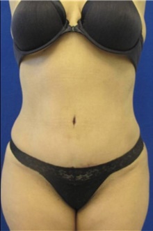 Tummy Tuck After Photo by Munique Maia, MD; Tysons Corner, VA - Case 48939