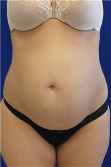 Tummy Tuck Before Photo by Munique Maia, MD; Tysons Corner, VA - Case 48939